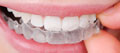 Essix or Clear Retainers