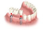 Bangkok Dental Implants, Dental Implant Bridge