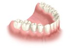 Bangkok Dental Implants, Dental Implant Bridge