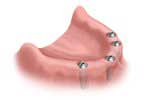 Bangkok Dental Implant, Fixed Bridges on Implants