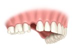 Bangkok Dental Implant, Single Implant