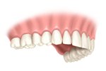 Bangkok Dental Implant, Single Implant
