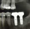 Bangkok Implants, Dental X-ray