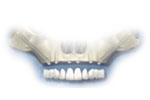 Bangkok Dental Implant, Fixed Bridges on Implants