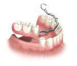Thailand Dental Partial Dentures