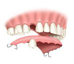 Bangkok Dental Partial Dentures